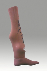 Przykład protezowego wyrównania kończyny z utrwalonym końskim ustawieniem stopy.